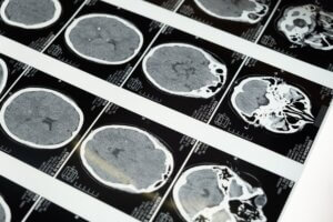 Lee más sobre el artículo <strong>Neuroderechos como defensa de los humanos ante posesión de datos cerebrales por empresas neurotecnológicas</strong>