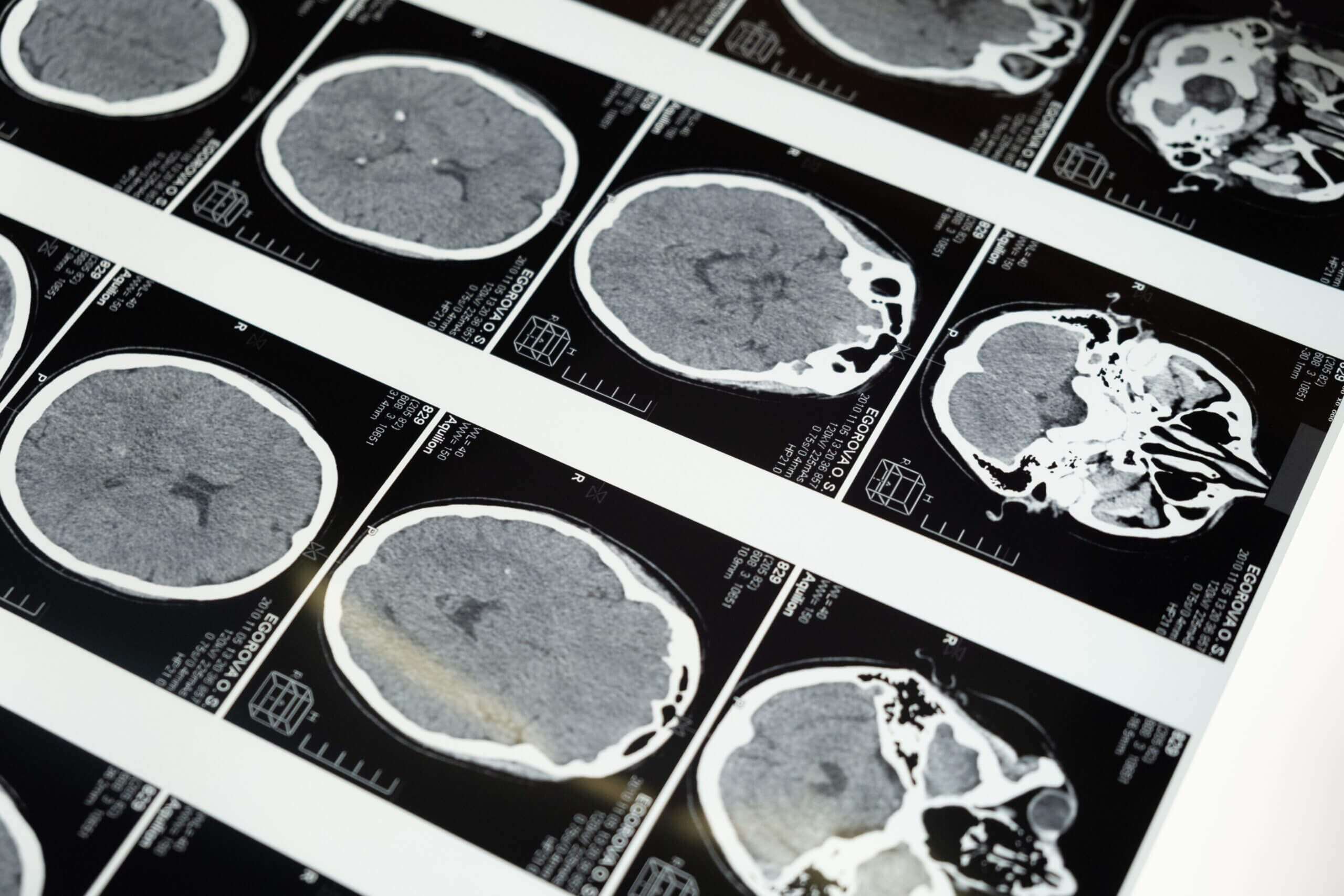 Lee más sobre el artículo <strong>Neuroderechos como defensa de los humanos ante posesión de datos cerebrales por empresas neurotecnológicas</strong>