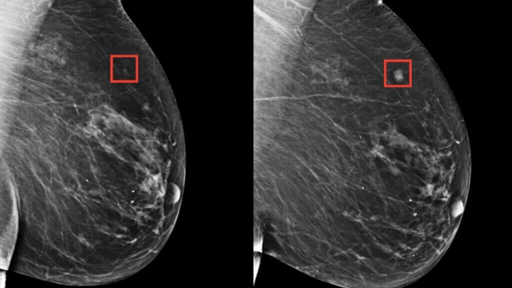 Estudio evidencia potencial de la IA como herramienta para la detección del cáncer de mama