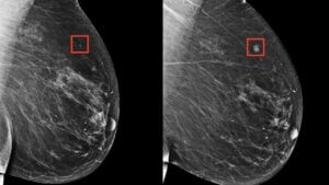 Lee más sobre el artículo Estudio evidencia potencial de la IA como herramienta para la detección del cáncer de mama