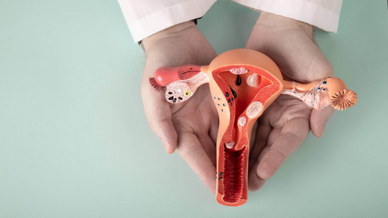 Lee más sobre el artículo Científicas estudian la asociación entre endometriosis y cáncer de ovario