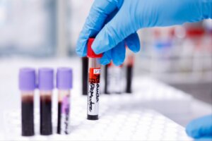 Lee más sobre el artículo Investigadores venezolanos estudian impacto de anticuerpos antiplaquetarios en la evolución del dengue y el SARS-Cov-2
