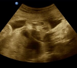 Lee más sobre el artículo Realizada con éxito la primera cirugía cardíaca valvular intrauterina en Venezuela
