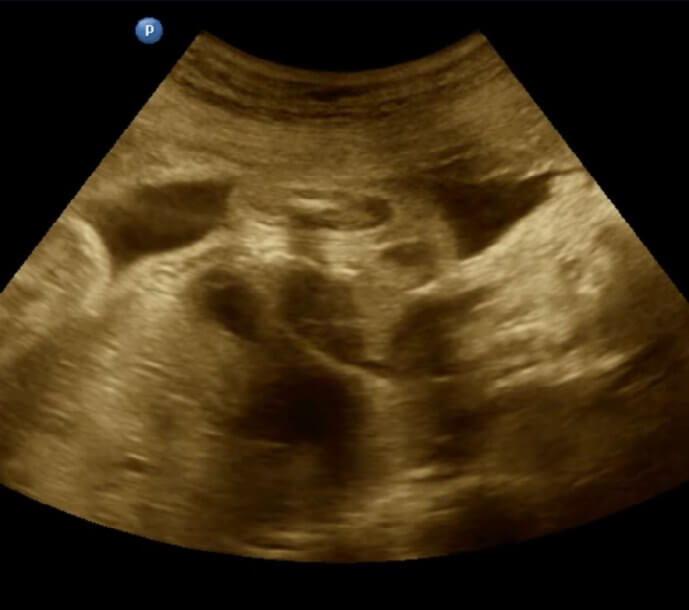En este momento estás viendo Realizada con éxito la primera cirugía cardíaca valvular intrauterina en Venezuela