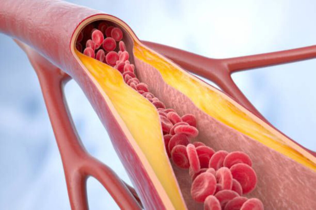 Investigadores españoles revelan que una molécula producida por la microbiota intestinal puede inducir a la aterosclerosis